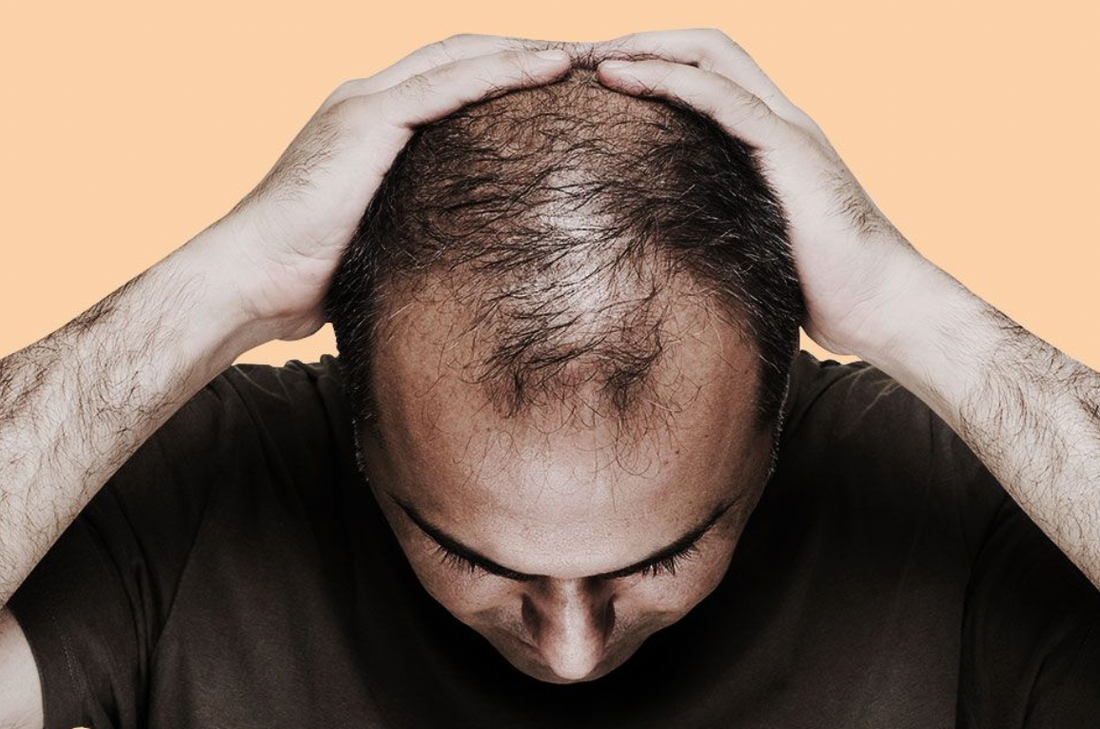 The hair loss pyramid: What is the best hair loss treatment for you?